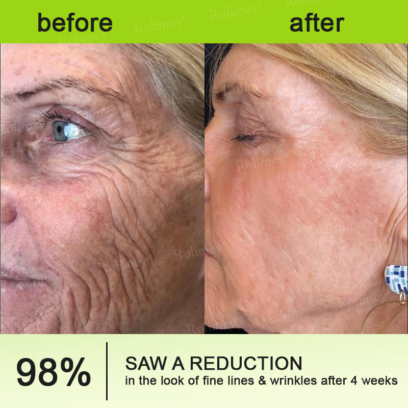 👨‍⚕️Made and shipped from USA💫 Botox & Vita-A Retinol Shot Wrinkle-Lift Tightening cream - Last Day Promotion 70% OFF