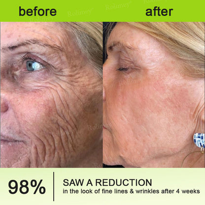 👨‍⚕️Made and shipped from USA💫 Botox & Vita-A Retinol Shot Wrinkle-Lift Tightening cream - Last Day Promotion 70% OFF